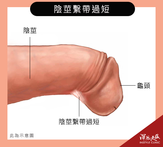 渾然天成•泌尿專科|陰莖繫帶過短易導致勃起時向下彎曲、疼痛。