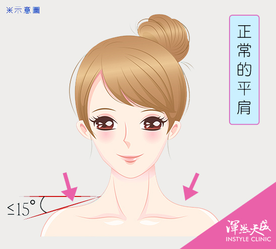 正常的平肩:小於15度較為正常的平肩。|渾然天成整形醫美 正常的平肩:小於15度較為正常的平肩。|渾然天成整形醫美