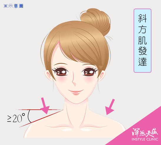 斜方肌發達:大於20度的斜肩(斜方肌發達)。|渾然天成整形醫美 斜方肌發達:大於20度的斜肩(斜方肌發達)。|渾然天成整形醫美