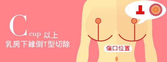 減胸,整形,女醫生,胸部,縮小,手術,女T,束胸,平胸,渾然天成,手術