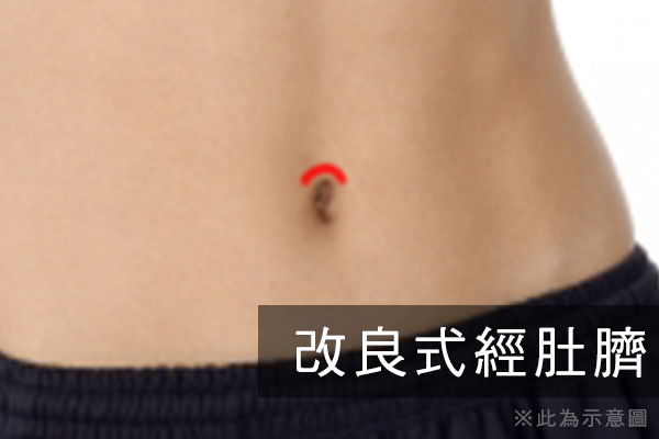 改良式經肚臍,跨性別,男性隆乳,變性,男變女, 偽娘,手術,隆乳,醫師,推薦,後悔,隱形隆乳,經肚臍隆乳,渾然天成,整形醫美,不分性別,水滴,蜜桃,內視鏡,美嬌娘,手術過程,近乎無痛,失敗,問題,傷口,陰影,疼痛,恢復期,照顧,圖,比基尼,內衣,按摩,胸肌,陳淑賢,內視鏡,隆乳材質,圓形果凍,水滴型果凍,矽膠,位置,方式