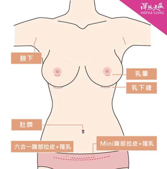 隆乳切口位置說明 隆乳切口位置說明