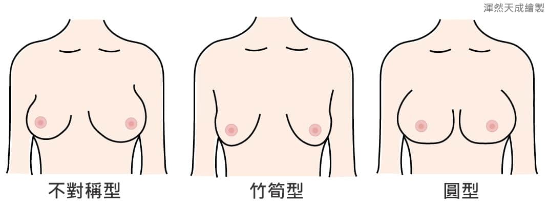 渾然天成自體脂肪豐胸,幫助許多愛美者量身打造完美曲線,是您選擇自體脂肪豐胸的理想整形診所