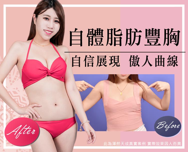 渾然天成自體脂肪隆乳,真實案例