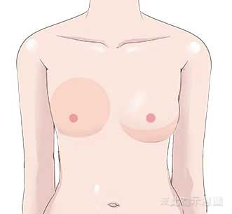 自體脂肪豐胸說明-填補後胸部模擬插圖