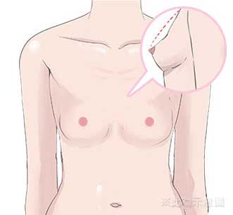 自體脂肪豐胸說明-填補前胸部模擬插圖