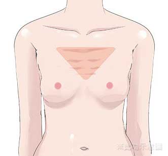 自體脂肪豐胸說明-填補後胸部模擬插圖