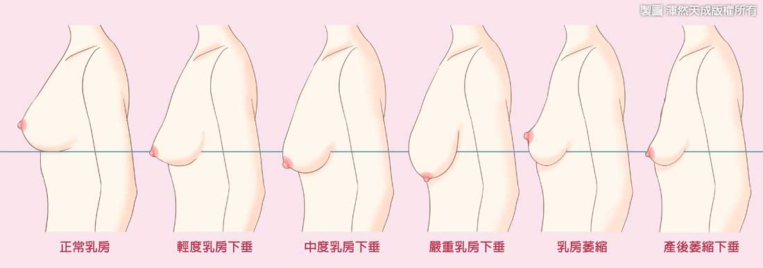 女性乳房发育不良图片