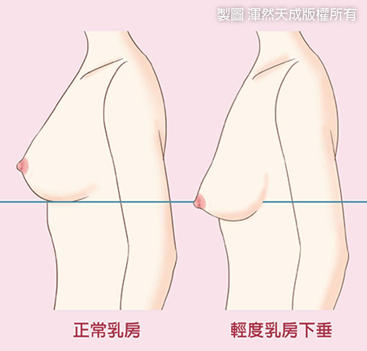 提乳-妳有乳房下垂嗎 提乳-妳有乳房下垂嗎