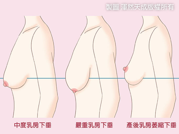 提乳-妳有乳房下垂嗎 提乳-妳有乳房下垂嗎
