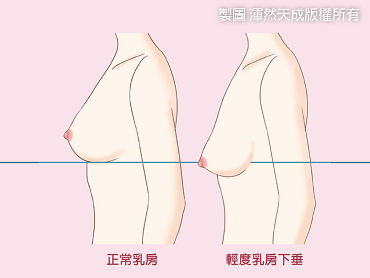 提乳-妳有乳房下垂嗎 提乳-妳有乳房下垂嗎