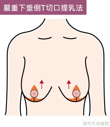 渾然天成經肚臍果凍隆乳適合怕留疤或是忙碌的族群，無論是工作需求或希望自己恢復美麗、更有自信都可以利用經肚臍果凍隆乳的優點