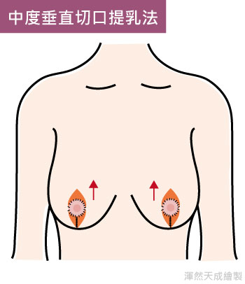 渾然天成經肚臍果凍隆乳適合怕留疤或是忙碌的族群，無論是工作需求或希望自己恢復美麗、更有自信都可以利用經肚臍果凍隆乳的優點