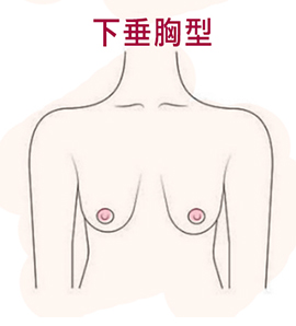 渾然天成整形醫美|Mentor曼陀水滴隆乳-各種常見胸型