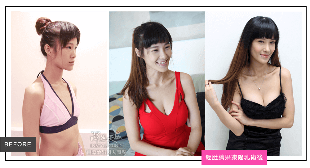 隆乳真實案例素人產後媽媽喬可,經肚臍果凍矽膠隆乳三組圖 隆乳真實案例素人產後媽媽喬可,經肚臍果凍矽膠隆乳三組圖