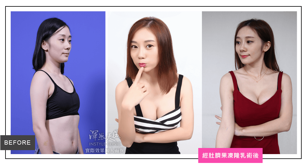 隆乳真實案例素人魚干女sunny,經肚臍果凍矽膠隆乳三組圖 隆乳真實案例素人魚干女sunny,經肚臍果凍矽膠隆乳三組圖