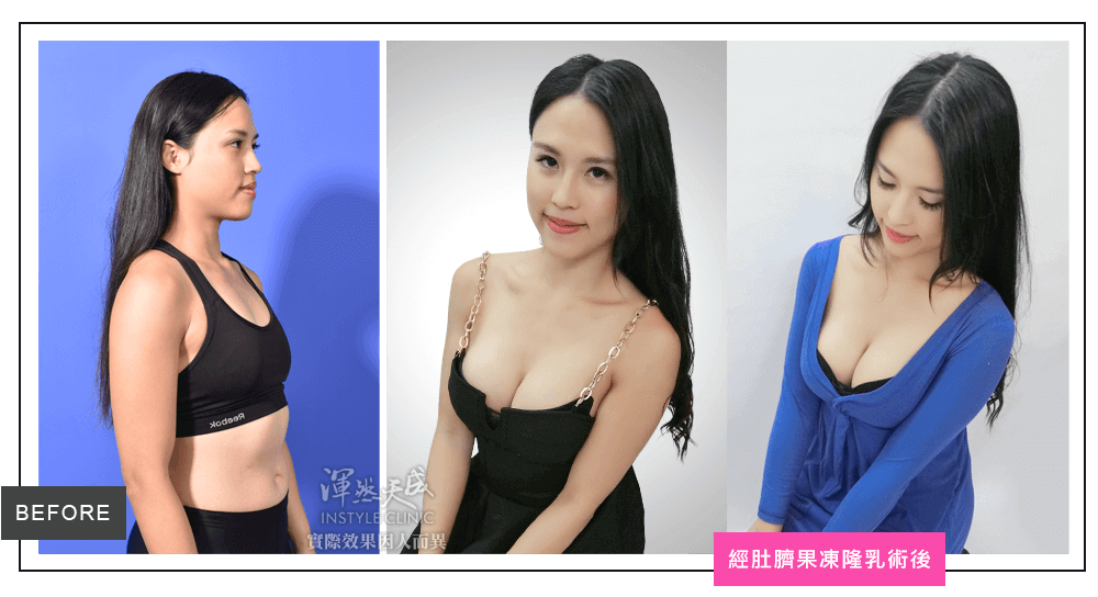 隆乳真實案例素人瑜珈老師,經肚臍果凍矽膠隆乳三組圖 隆乳真實案例素人瑜珈老師,經肚臍果凍矽膠隆乳三組圖