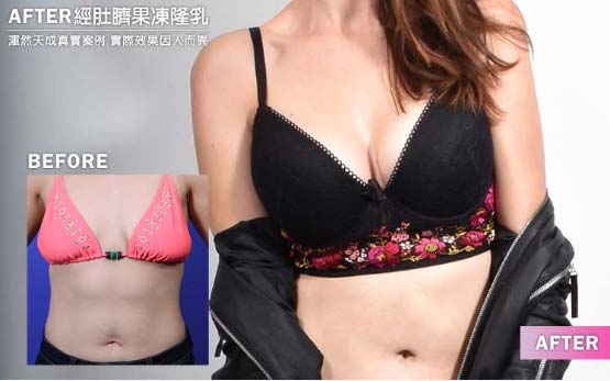 渾然天成經肚臍隆乳 渾然天成經肚臍隆乳