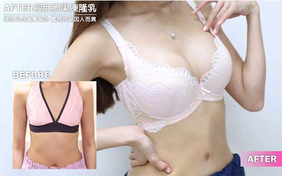 肚臍果凍矽膠隆乳真實案例家家術後照片 肚臍果凍矽膠隆乳真實案例家家術後照片