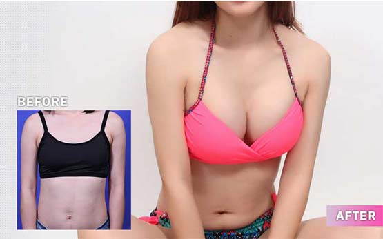 肚臍果凍矽膠隆乳真實案例狗狗術後照片 肚臍果凍矽膠隆乳真實案例狗狗術後照片