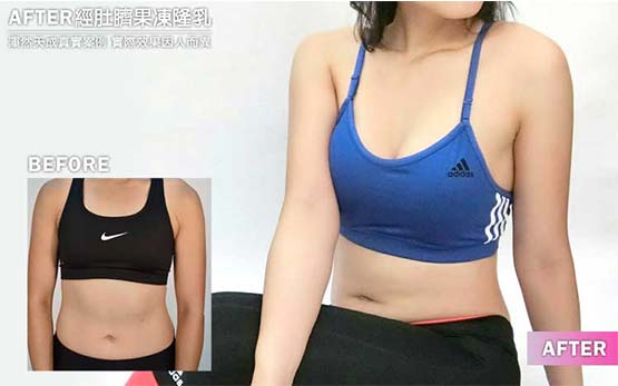肚臍果凍矽膠隆乳真實案例小珍術後照片 肚臍果凍矽膠隆乳真實案例小珍術後照片