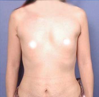 脊椎側彎、左肩高、乳頭高低差 脊椎側彎、左肩高、乳頭高低差