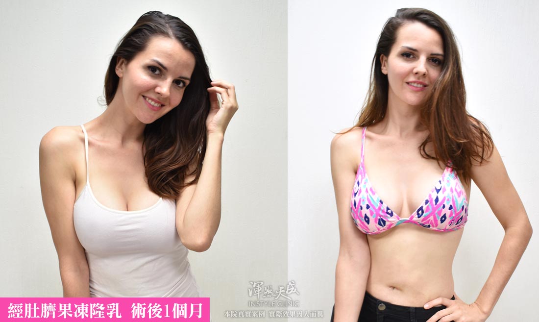 肚臍果凍矽膠隆乳術後一個月 肚臍果凍矽膠隆乳術後一個月