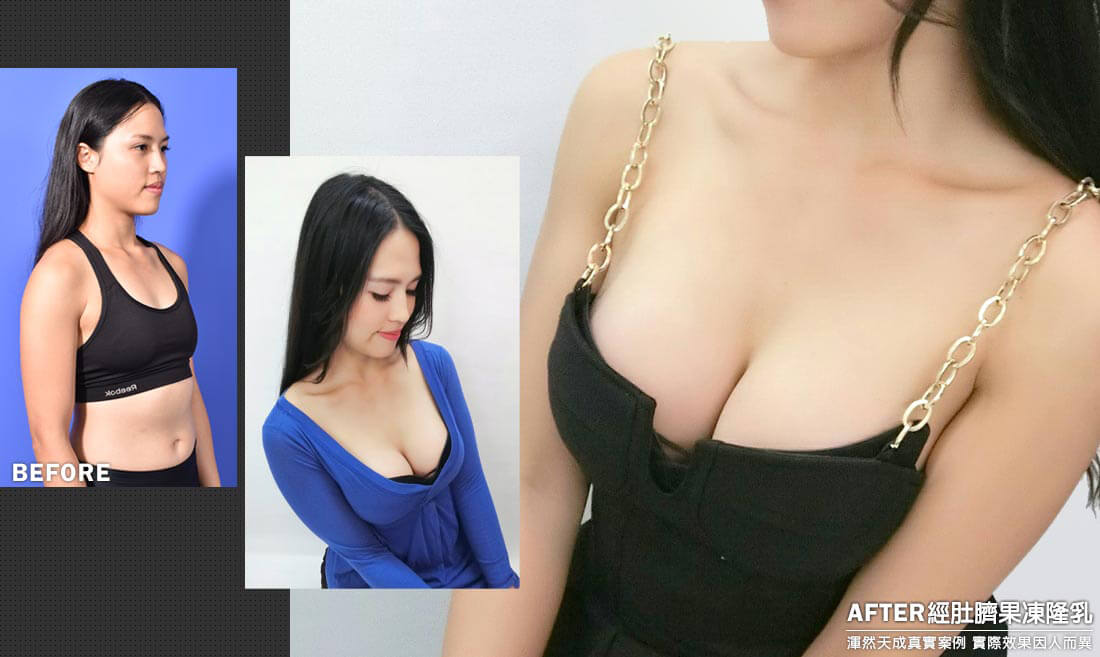 隆乳真實案例素人瑜珈老師,經肚臍果凍矽膠隆乳效果隱形匿蹤藏疤痕 隆乳真實案例素人瑜珈老師,經肚臍果凍矽膠隆乳效果隱形匿蹤藏疤痕