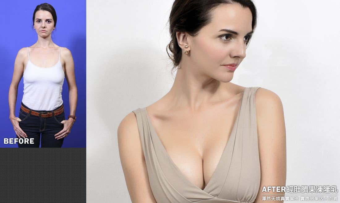 隆乳真實案例素人法國名模Lina,經肚臍果凍矽膠隆乳效果隱形匿蹤藏疤痕 隆乳真實案例素人法國名模Lina,經肚臍果凍矽膠隆乳效果隱形匿蹤藏疤痕