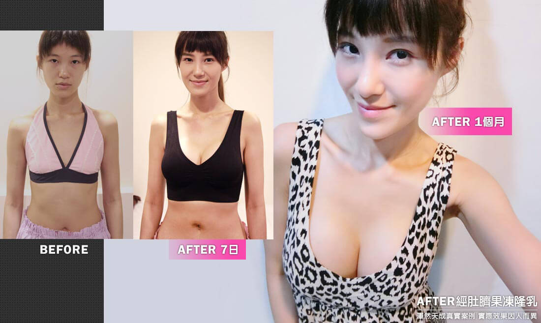 隆乳真實案例素人產後媽媽喬可,經肚臍果凍矽膠隆乳效果隱形匿蹤藏疤痕 隆乳真實案例素人產後媽媽喬可,經肚臍果凍矽膠隆乳效果隱形匿蹤藏疤痕