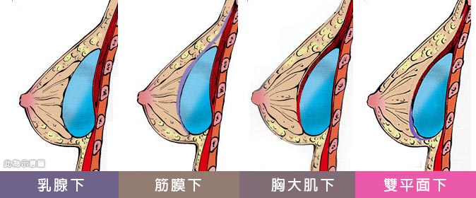 隆乳材質放入胸部的哪個位置? 隆乳材質放入胸部的哪個位置?