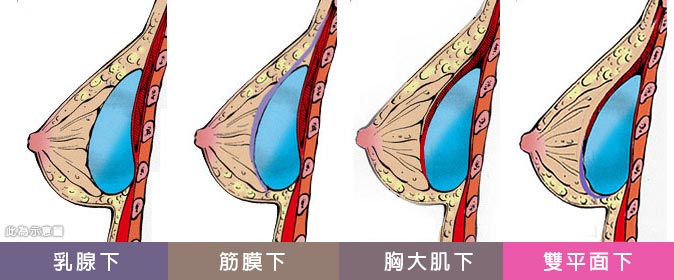 隆乳材質放入胸部的哪個位置？