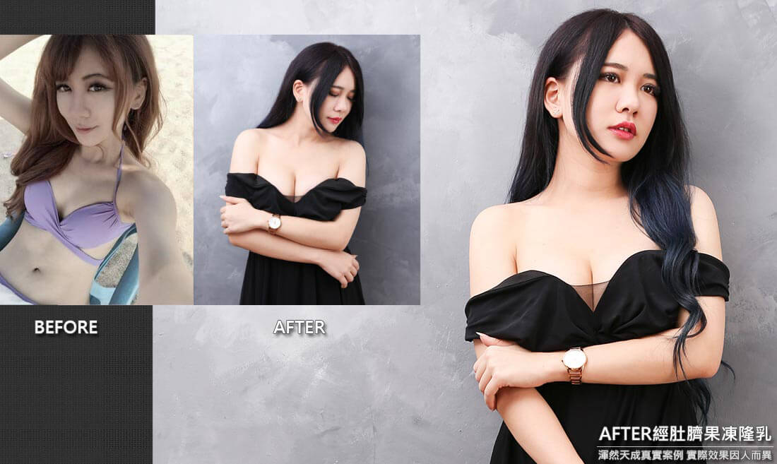 隆乳真實案例素人狗狗,經肚臍果凍矽膠隆乳效果隱形匿蹤藏疤痕 隆乳真實案例素人狗狗,經肚臍果凍矽膠隆乳效果隱形匿蹤藏疤痕