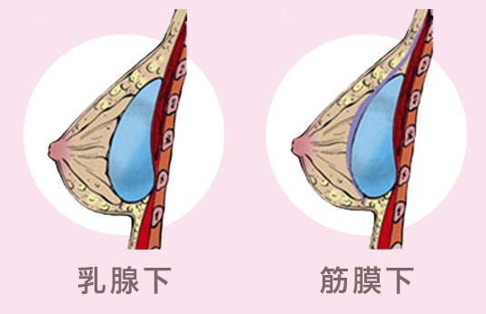 隆乳位置,義乳,大小,放哪,按摩,術後保養,恢復,快,簡單,近乎無痛,無疤,手術,安全, 麻醉,風險,醫療品質,醫療院所,合格,通過, 適合,隆乳,手術,方法,效果,安全,醫師,推薦,比基尼,上圍,傲人,美胸,36D,E奶,胸罩,按摩,會痛嗎,疼痛,恢復,風險,小胸部,平胸,貧乳,渾然天成,手術,方法,按摩,快速,有效,圖,傷口,疤痕,乳房檢查,核磁共振,整形診所,推薦,醫師,女醫師,網友最愛,首推,第一,唯一,真實案例,經驗,尺寸,大小,整專字號,藥,近乎無痛,怕痛,快,好