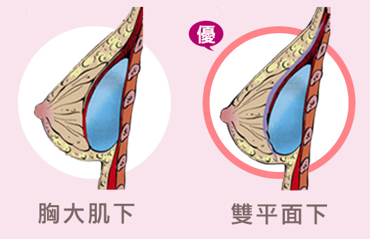 隆乳位置,義乳,大小,放哪,按摩,術後保養,恢復,快,簡單,近乎無痛,無疤,手術,安全, 麻醉,風險,醫療品質,醫療院所,合格,通過, 適合,隆乳,手術,方法,效果,安全,醫師,推薦,比基尼,上圍,傲人,美胸,36D,E奶,胸罩,按摩,會痛嗎,疼痛,恢復,風險,小胸部,平胸,貧乳,渾然天成,手術,方法,按摩,快速,有效,圖,傷口,疤痕,乳房檢查,核磁共振,整形診所,推薦,醫師,女醫師,網友最愛,首推,第一,唯一,真實案例,經驗,尺寸,大小,整專字號,藥,近乎無痛,怕痛,快,好