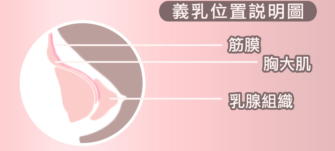 隆乳位置,義乳,大小,放哪,按摩,術後保養,恢復,快,簡單,近乎無痛,無疤,手術,安全, 麻醉,風險,醫療品質,醫療院所,合格,通過, 適合,隆乳,手術,方法,效果,安全,醫師,推薦,比基尼,上圍,傲人,美胸,36D,E奶,胸罩,按摩,會痛嗎,疼痛,恢復,風險,小胸部,平胸,貧乳,渾然天成,手術,方法,按摩,快速,有效,圖,傷口,疤痕,乳房檢查,核磁共振,整形診所,推薦,醫師,女醫師,網友最愛,首推,第一,唯一,真實案例,經驗,尺寸,大小,整專字號,藥,近乎無痛,怕痛,快,好