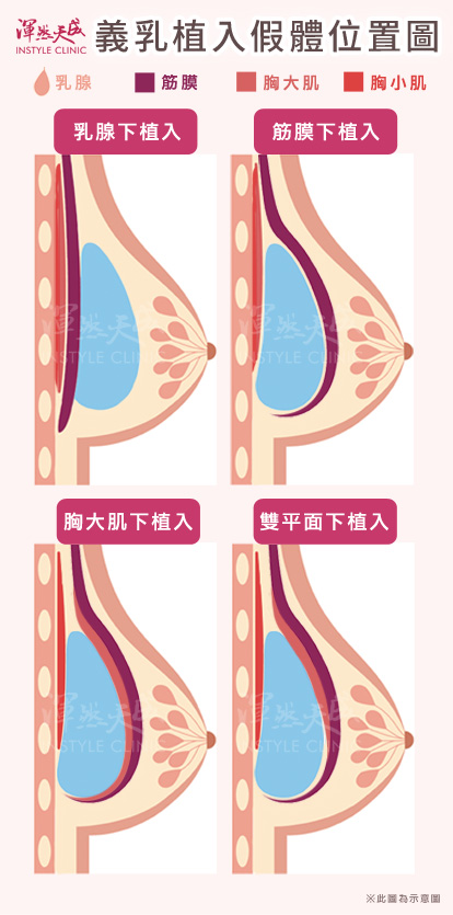 隆乳-義乳隆乳材質植入位置說明圖|渾然天成整形醫美 隆乳-義乳隆乳材質植入位置說明圖|渾然天成整形醫美