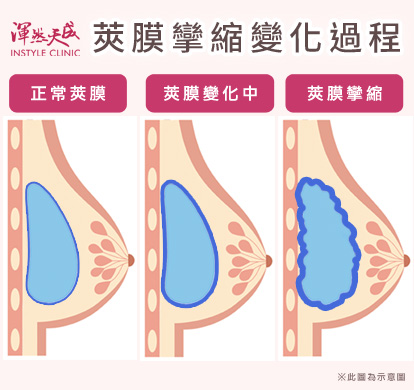 隆乳-莢膜攣縮變化圖|渾然天成整形醫美 隆乳-莢膜攣縮變化圖|渾然天成整形醫美