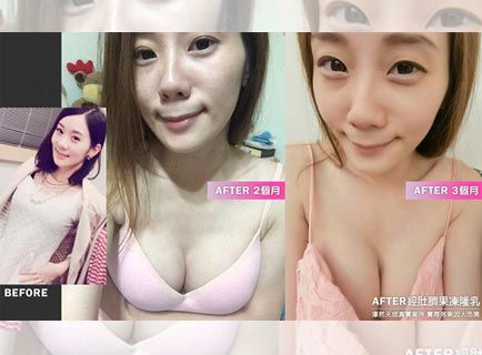 乳形定型時間-1 植入位置乳形定型時間-1