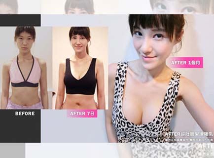 乳形定型時間-4 植入位置乳形定型時間-4