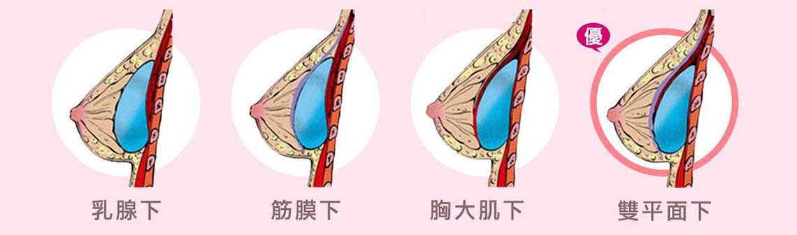 隆乳植入位置分為四種,須由專業醫師評估個人條件後放置 假體植入在胸部的哪一個位置