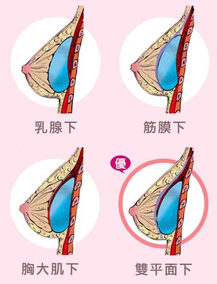 隆乳植入位置分為四種,須由專業醫師評估個人條件後放置 假體植入在胸部的哪一個位置