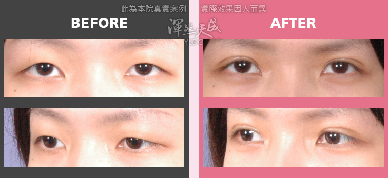 雙眼皮案例,渾然天成雙眼皮