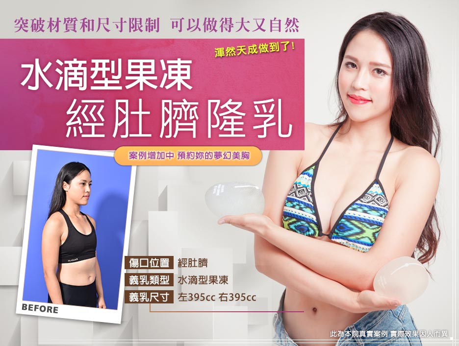 隆乳前後,經肚臍隆乳,心得,渾然天成,乳溝,乳神,整形權威,隆乳,乳溝,醫師