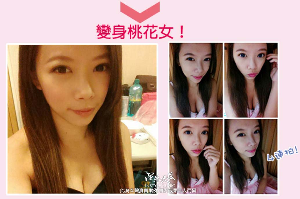 自體脂肪補臉,渾然天成雙眼皮,縫雙眼皮,墊下巴,案例,效果,渾然天成,評價