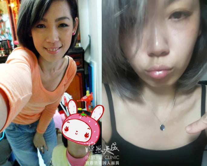 平胸,產後胸不縮水,哺乳,憔悴,變老,沒精神,黃臉婆,沒自信,渾然天成,自體豐胸,胸部,親餵