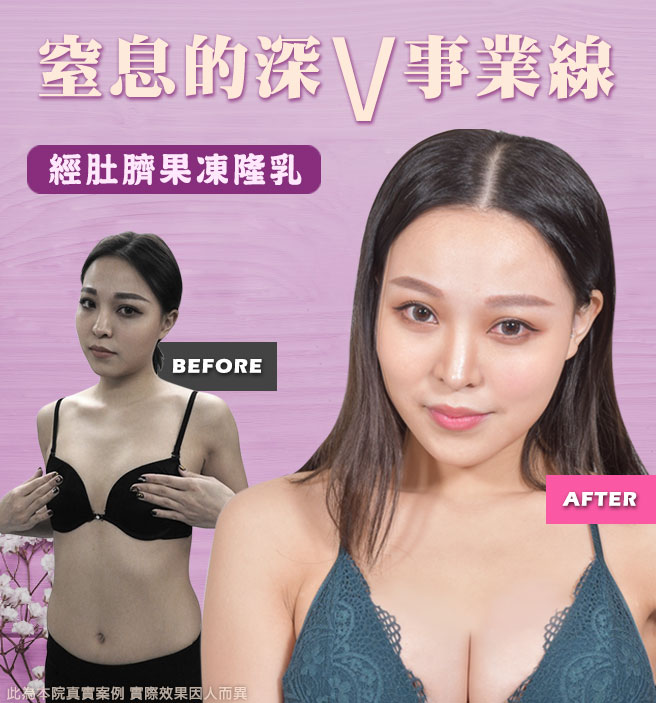 隆乳,隱形隆乳,渾然天成