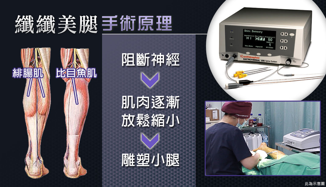 渾然天成整形醫美|小腿肌肉 渾然天成整形醫美|小腿肌肉