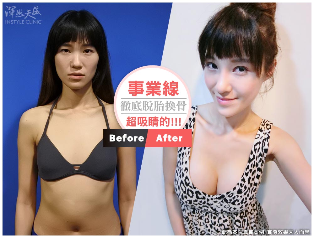 美編插圖 關鍵字:產後,隆乳心得,手術,整形,經肚臍隆乳,推薦,隱形隆乳,推薦