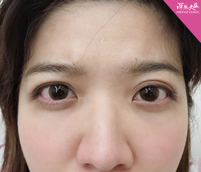渾然天成整形醫美-雙眼皮-醫師也有整型需求？告別無神、大小眼